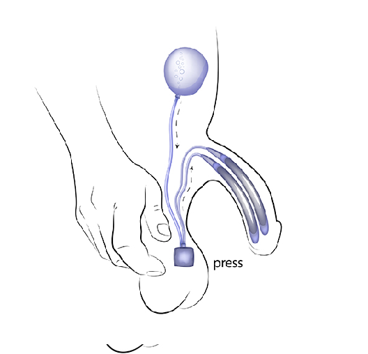 Three Piece Inflatable Penile Implant